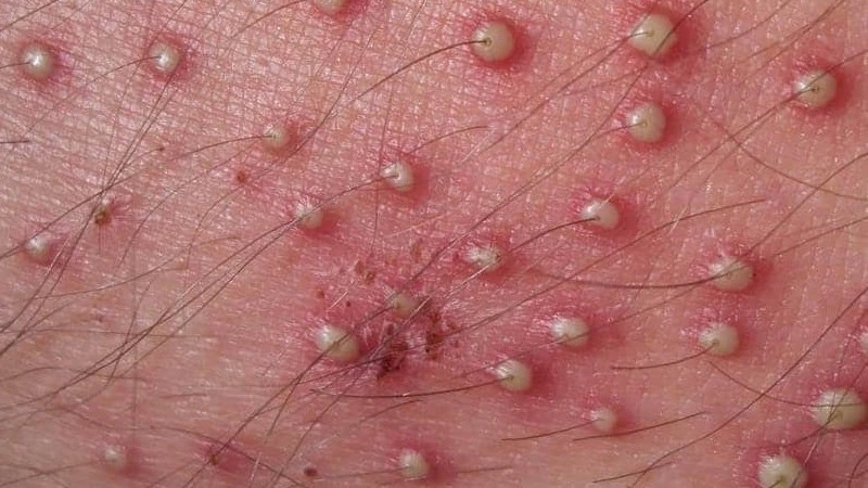 Viêm nang lông: Nguyên nhân, dấu hiệu và cách điều trị hiệu quả