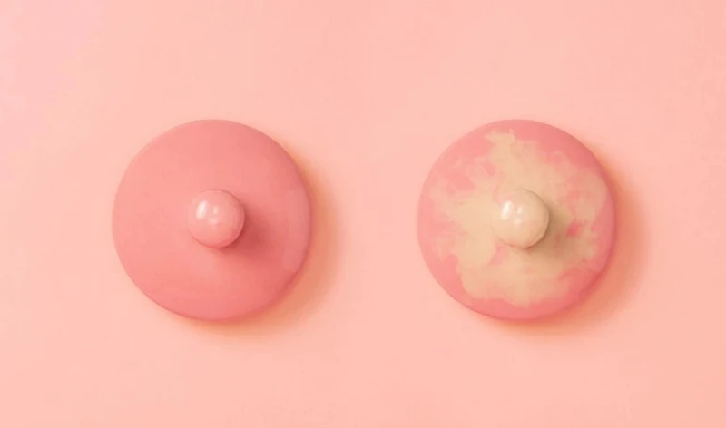 Nhũ hoa là gì? Dấu hiệu nhũ hoa đang không khỏe và cách chăm sóc