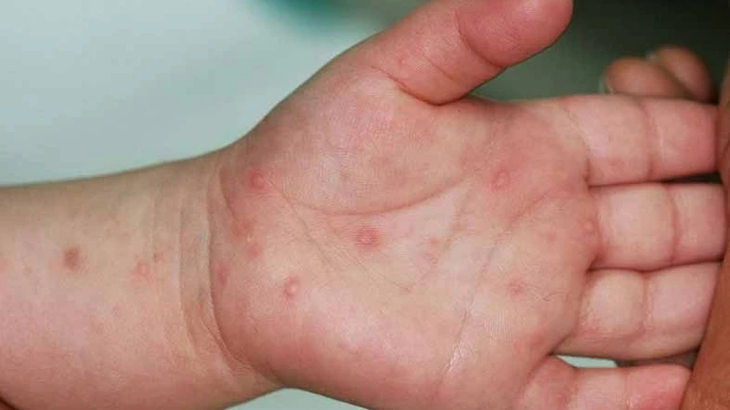 Cách điều trị bệnh tay chân miệng tại nhà an toàn và hiệu quả