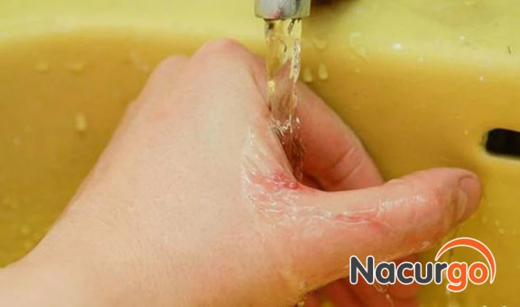 Hướng dẫn cách sát trùng vết thương bị ngã, té xe tránh nhiễm trùng!