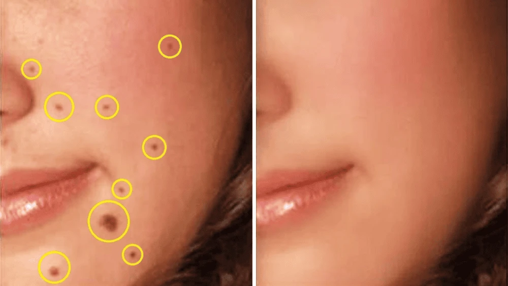 Tẩy nốt ruồi bị thâm có hết không? Tìm hiểu ngay