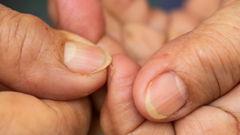 Nhìn Móng Tay Đoán Bệnh Cơ Thể Bạn