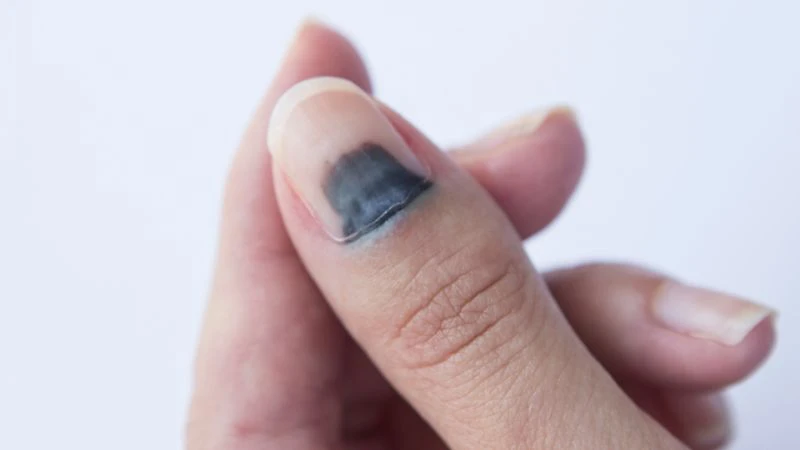 Móng tay màu tím và sức khỏe: Dấu hiệu cảnh báo