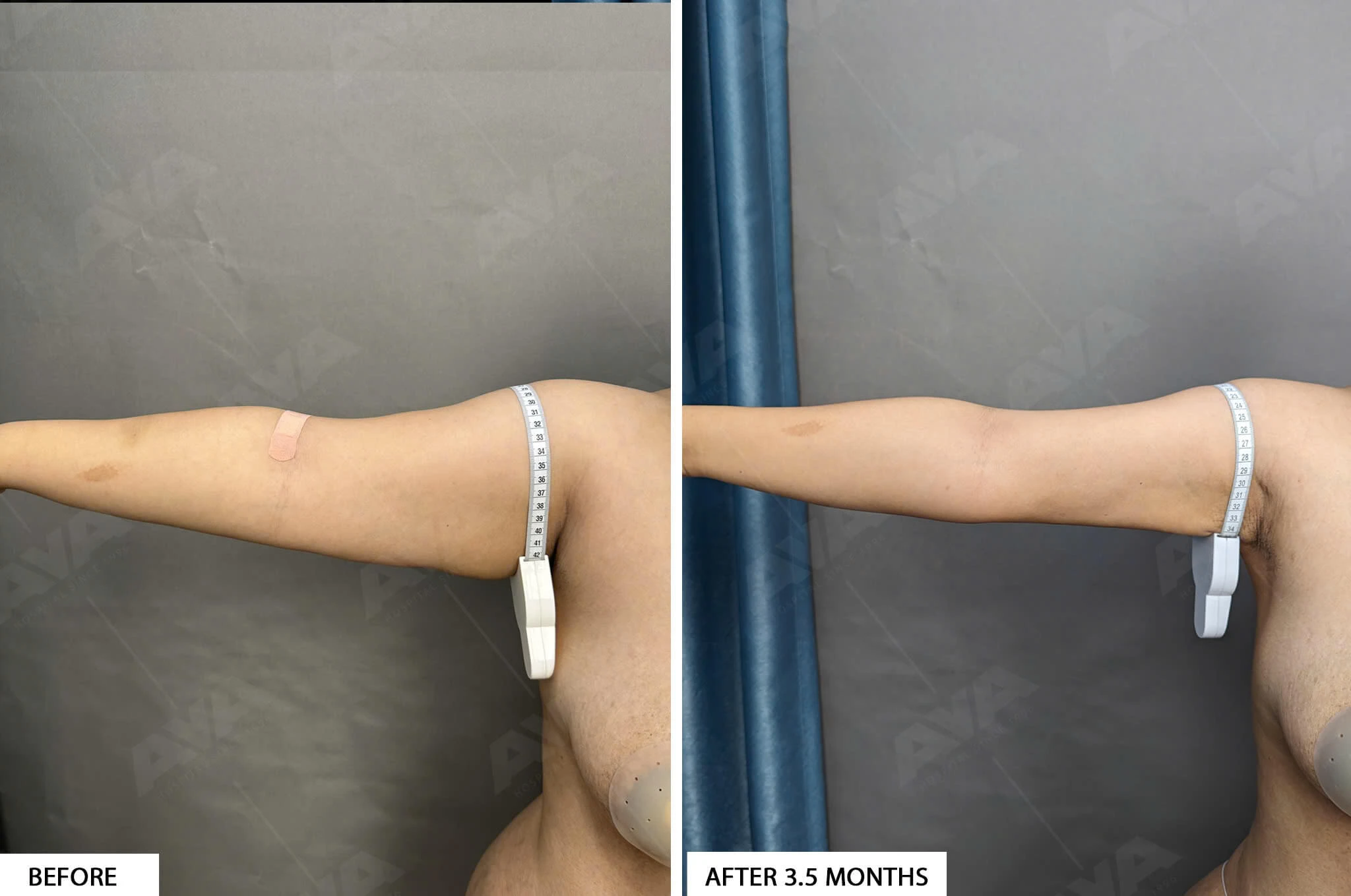 HÚT MỠ BẮP TAY VÀ LIỆU TRÌNH PHỤC HỒI SAU THỦ THUẬT Hút mỡ bắp tay giúp cải thiện và săn chắc vùng bắp tay, thường được áp dụng khi các biện pháp tập thể dục và chế độ ăn kiêng không mang lại hiệu quả. Liệu trình phục hồi sau thủ thuật được chú trọng để đảm bảo an toàn và giảm nguy cơ biến chứng. 