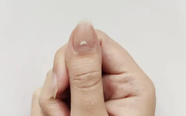 Nguyên nhân và biện pháp cho đốm trắng trên móng tay