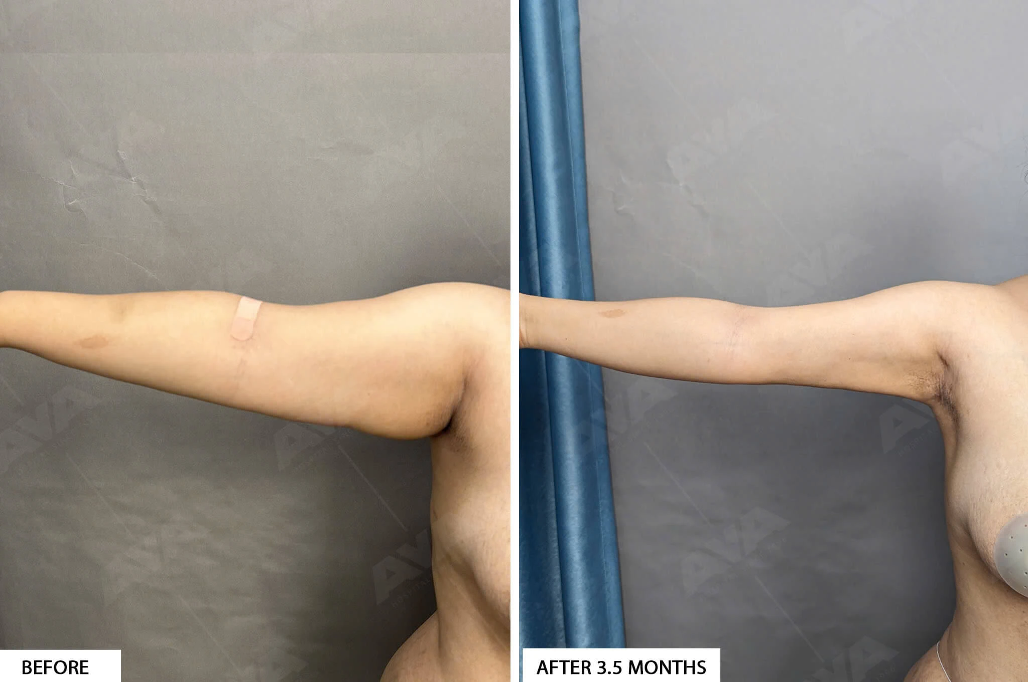 HÚT MỠ BẮP TAY VÀ LIỆU TRÌNH PHỤC HỒI SAU THỦ THUẬT Hút mỡ bắp tay giúp cải thiện và săn chắc vùng bắp tay, thường được áp dụng khi các biện pháp tập thể dục và chế độ ăn kiêng không mang lại hiệu quả. Liệu trình phục hồi sau thủ thuật được chú trọng để đảm bảo an toàn và giảm nguy cơ biến chứng. 