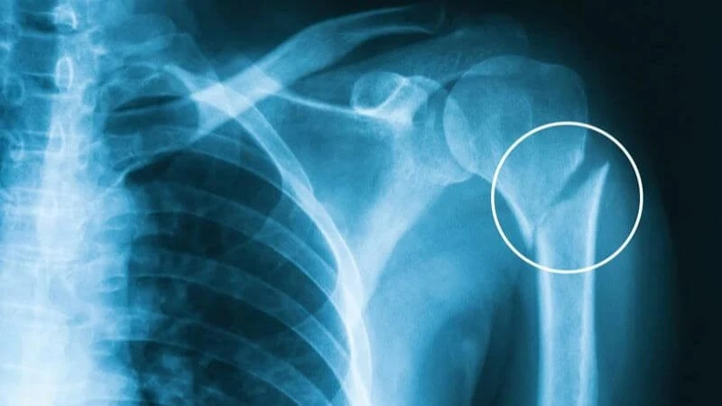 Hiểu biết về gãy xương cánh tay và cách điều trị