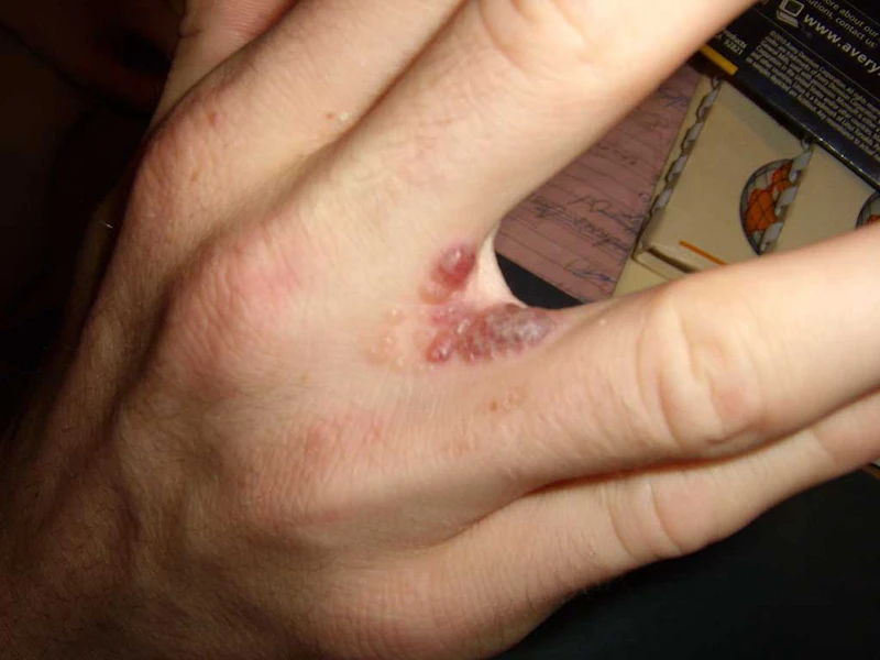 Ngứa kẽ ngón tay: Nguyên nhân và cách điều trị hiệu quả