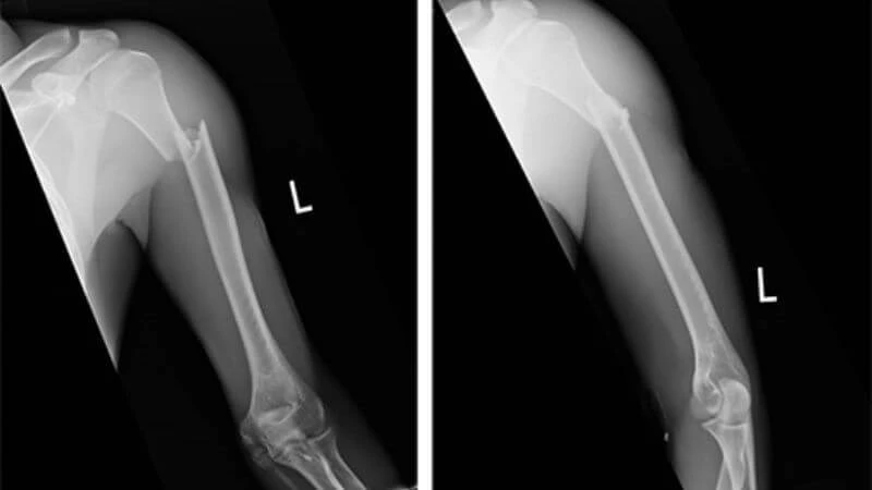 Gãy xương vùng cánh tay: Dấu hiệu, cách sơ cứu và điều trị