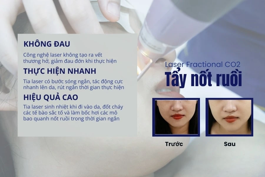 Nốt ruồi ở kẽ ngón tay có ý nghĩa gì? Sung sướng hay vất vả?