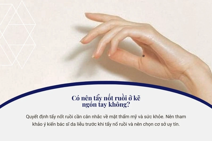 Nốt ruồi ở kẽ ngón tay có ý nghĩa gì? Sung sướng hay vất vả?