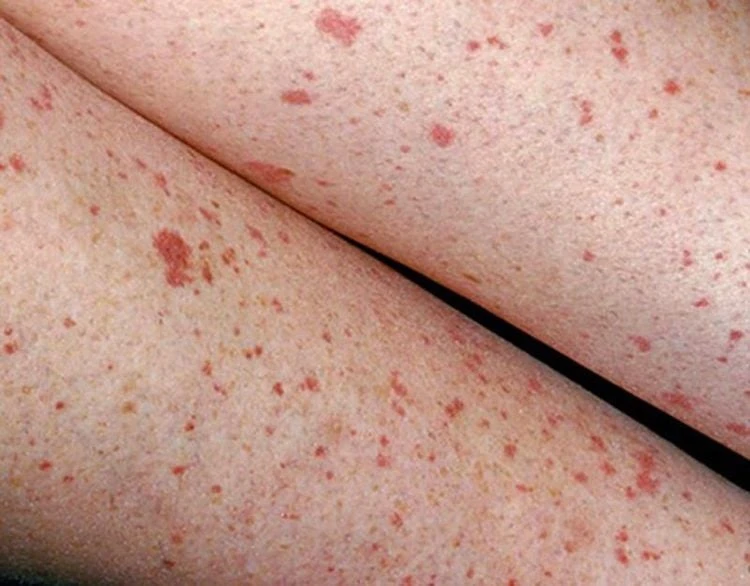 Xuất huyết dưới da ở cẳng tay: Nguyên nhân và điều trị