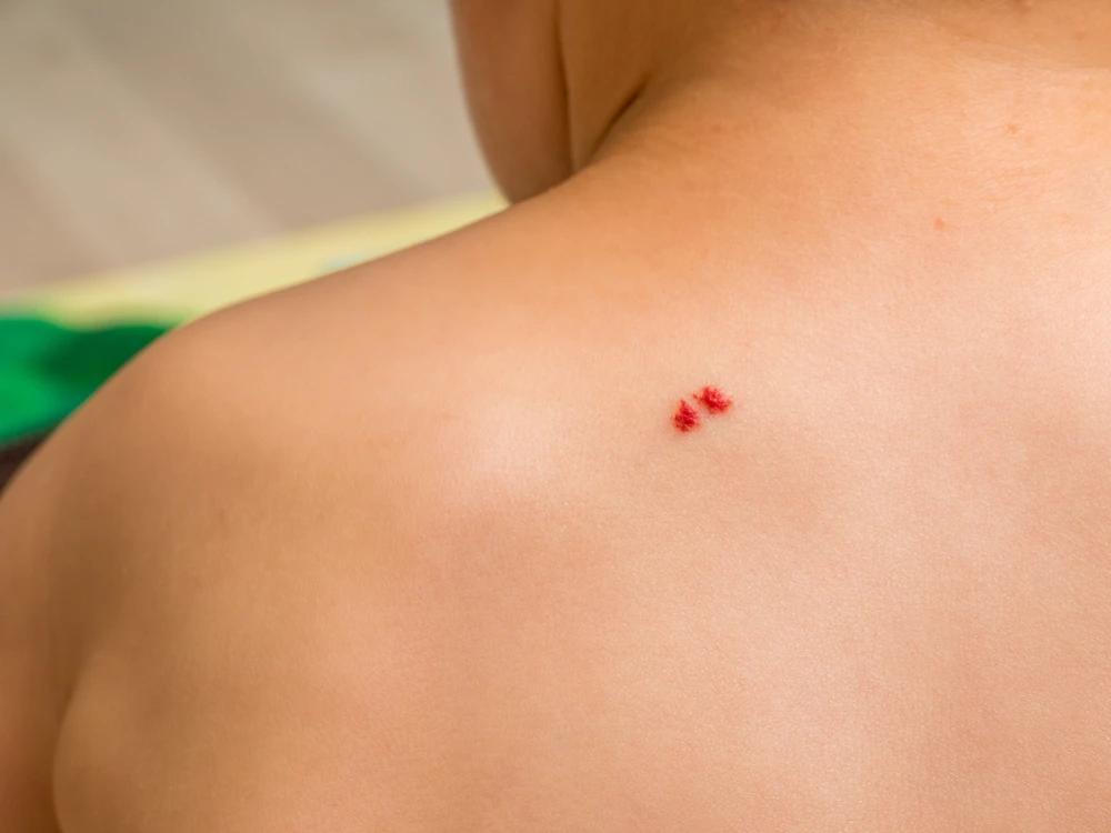 Nốt ruồi phong thủy ở tay và ý nghĩa của chúng