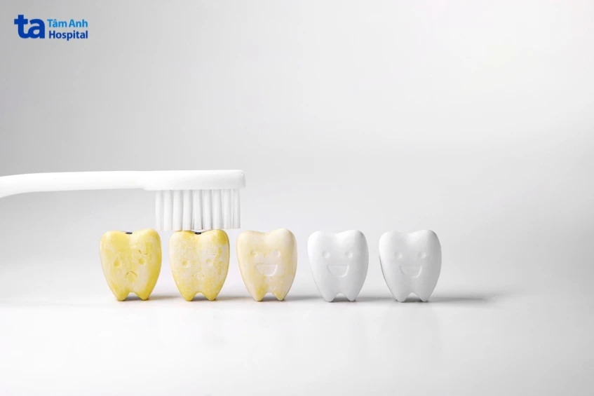 Răng ố vàng: Nguyên nhân, cách khắc phục và hạn chế ngả vàng