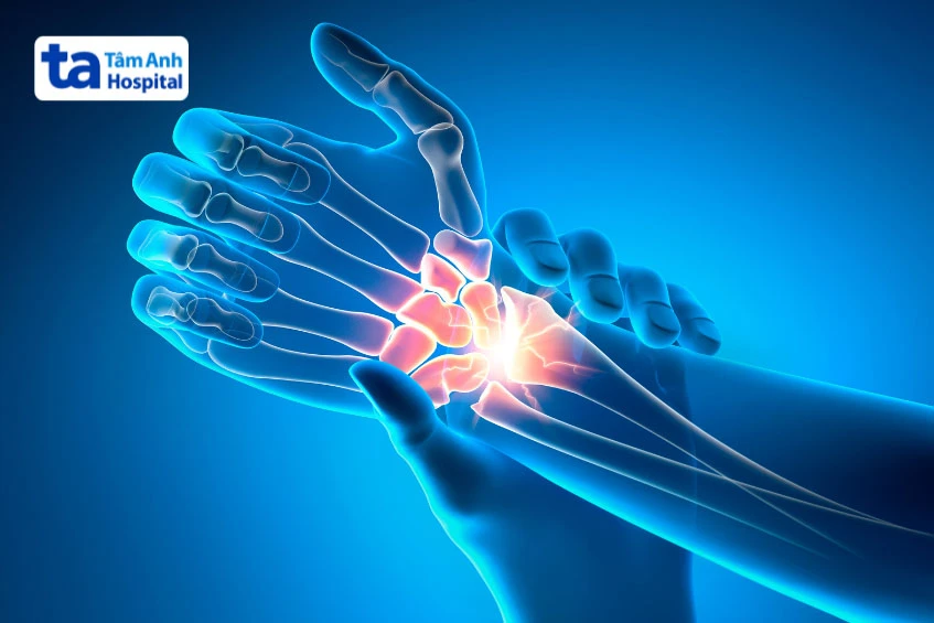 Bị cứng khớp cổ tay: Nguyên nhân, triệu chứng và cách chữa trị
