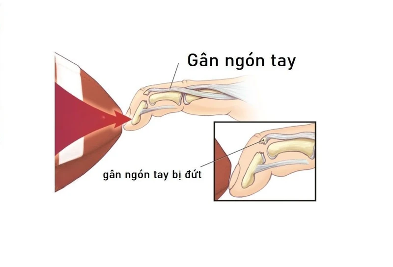 Đứt gân tay bao lâu thì khỏi và cách phục hồi hiệu quả
