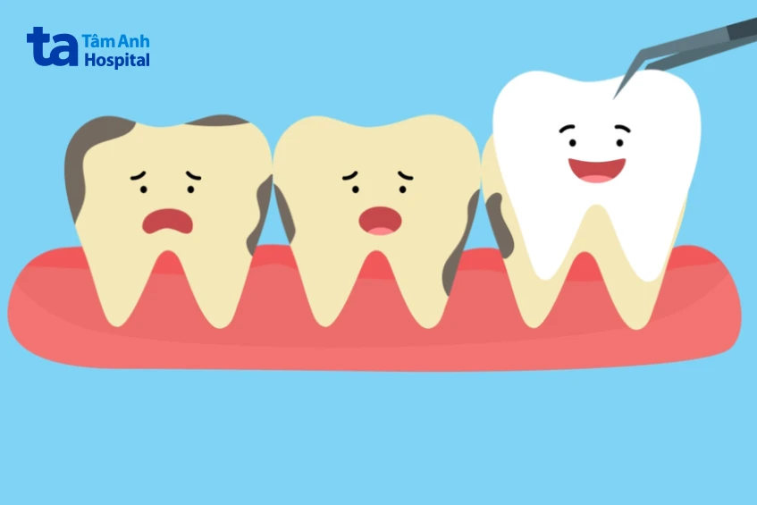 Răng ố vàng: Nguyên nhân, cách khắc phục và hạn chế ngả vàng