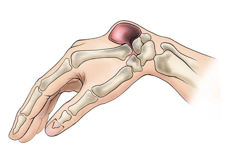Nhận biết tay nổi cục u không đau: Nguyên nhân và cách xử lý
