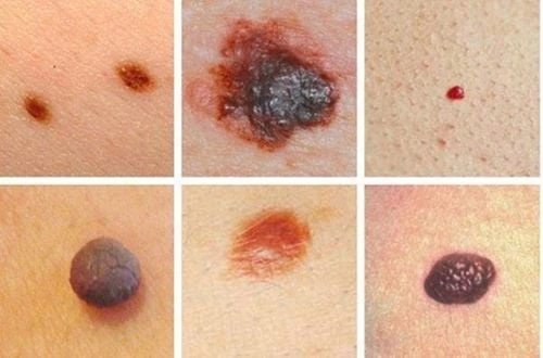 Ý Nghĩa Nốt Ruồi Mu Bàn Tay Trong Cuộc Sống