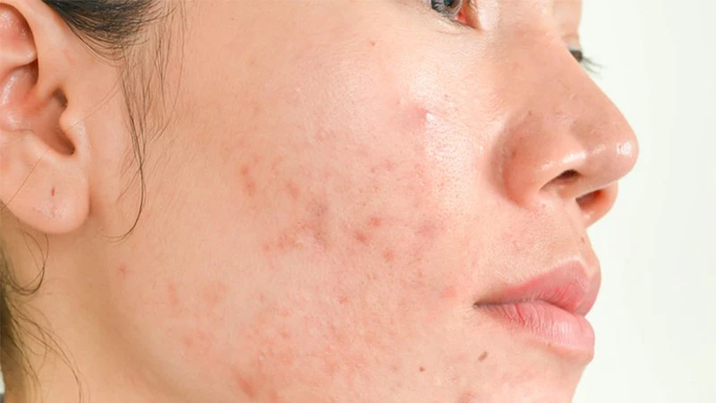 12 tác dụng của nước hoa hồng giúp nàng khỏe đẹp mỗi ngày