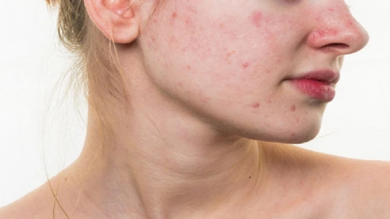 12 tác dụng của nước hoa hồng giúp nàng khỏe đẹp mỗi ngày