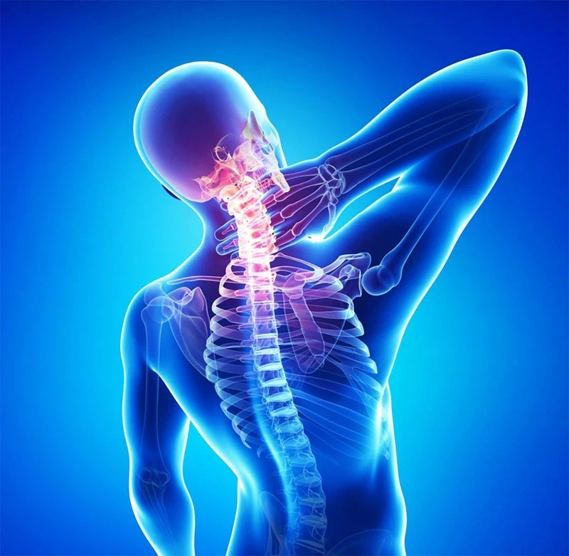 Thoái hóa đốt sống cổ chèn dây thần kinh và triệu chứng