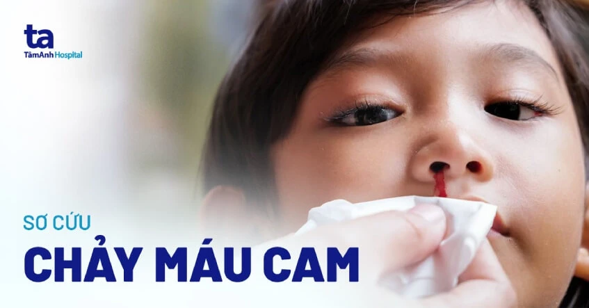 Cách Sử Dụng Khăn Giấy Khi Chảy Máu Cam An Toàn